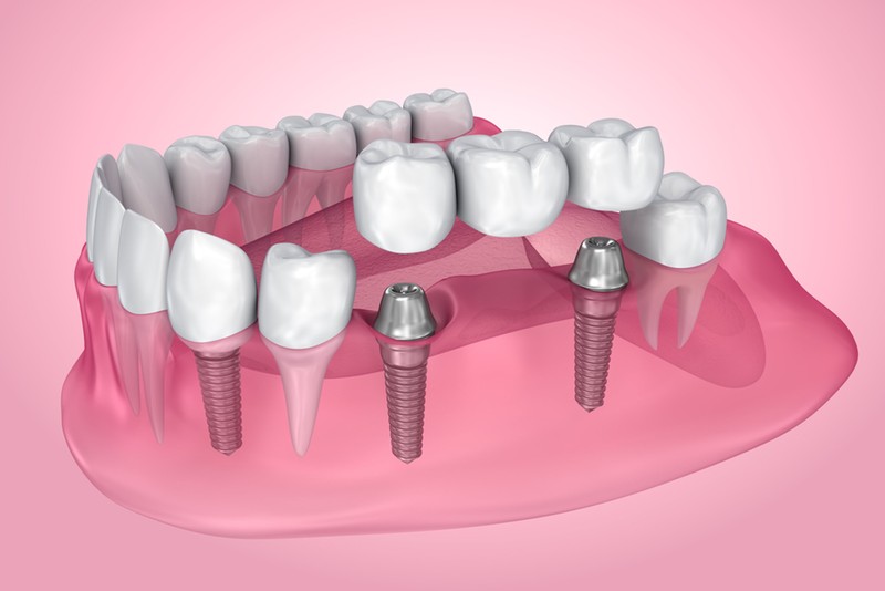 The Pros and Cons of Dental Implants: Everything You Need to Know