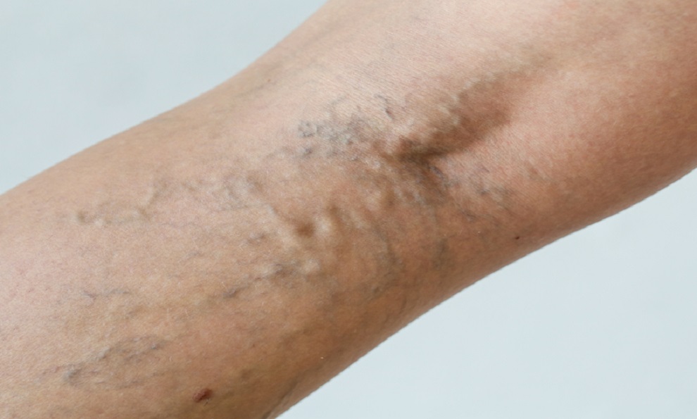 The Vein Dilemma – Navigating Varicose and Spider Veins in Singapore