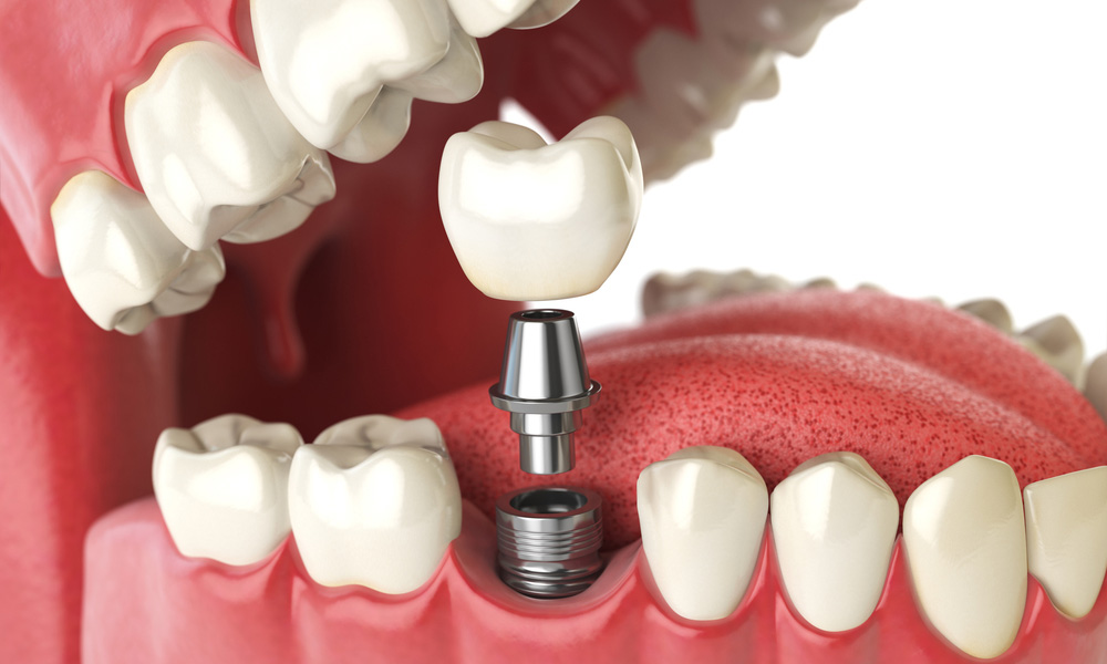 dental implants