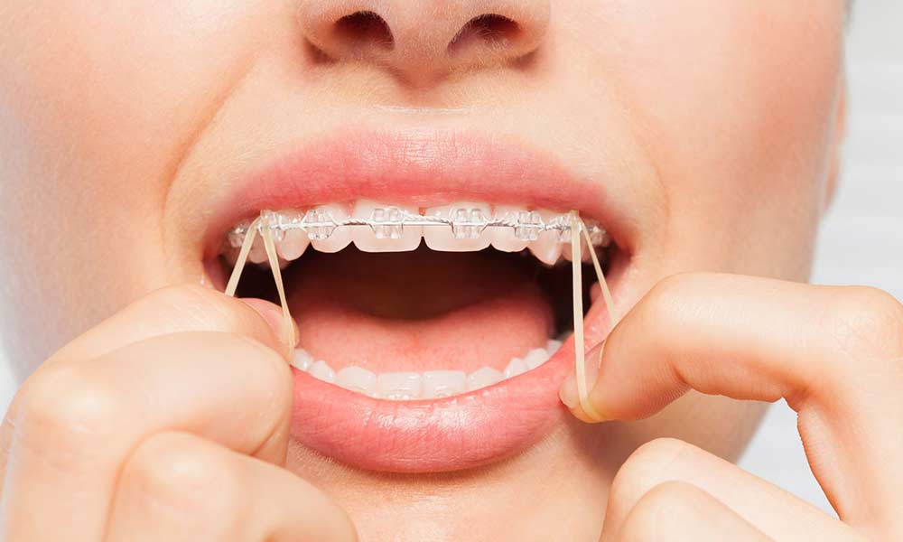 Orthodontic Spacers: What to Expect During the Process