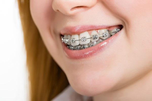 Orthodontic Spacers