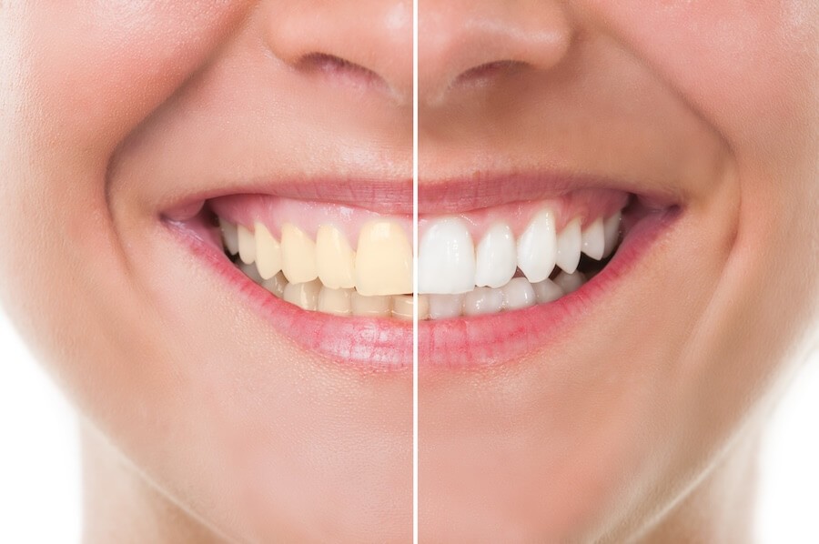 The Science Behind Teeth Whitening: Does It Really Work?